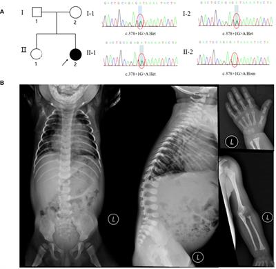 Case report: A novel splice-site mutation of MTX2 gene caused mandibuloacral dysplasia progeroid syndrome: the first report from China and literature review